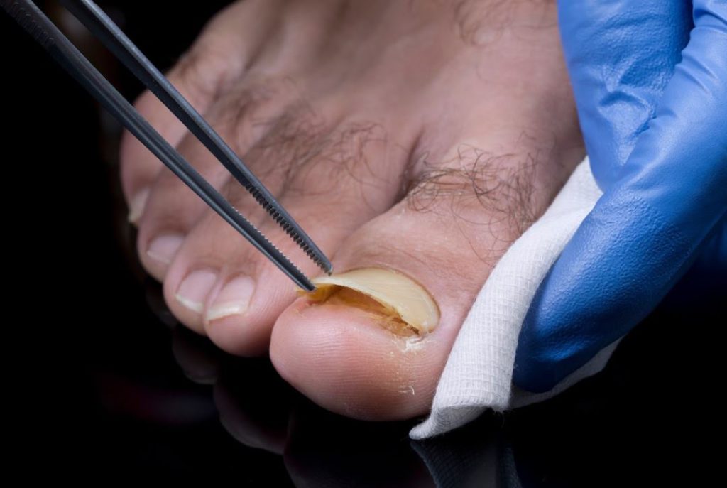 What Happens if Toenail Fungus Is Not Treated?