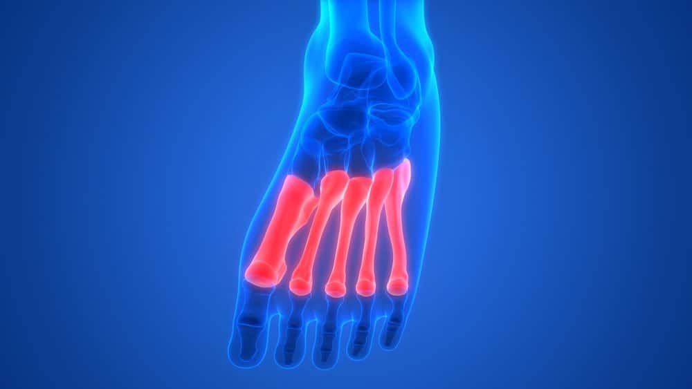 Factors Affecting Recovery 2nd metatarsal surgery