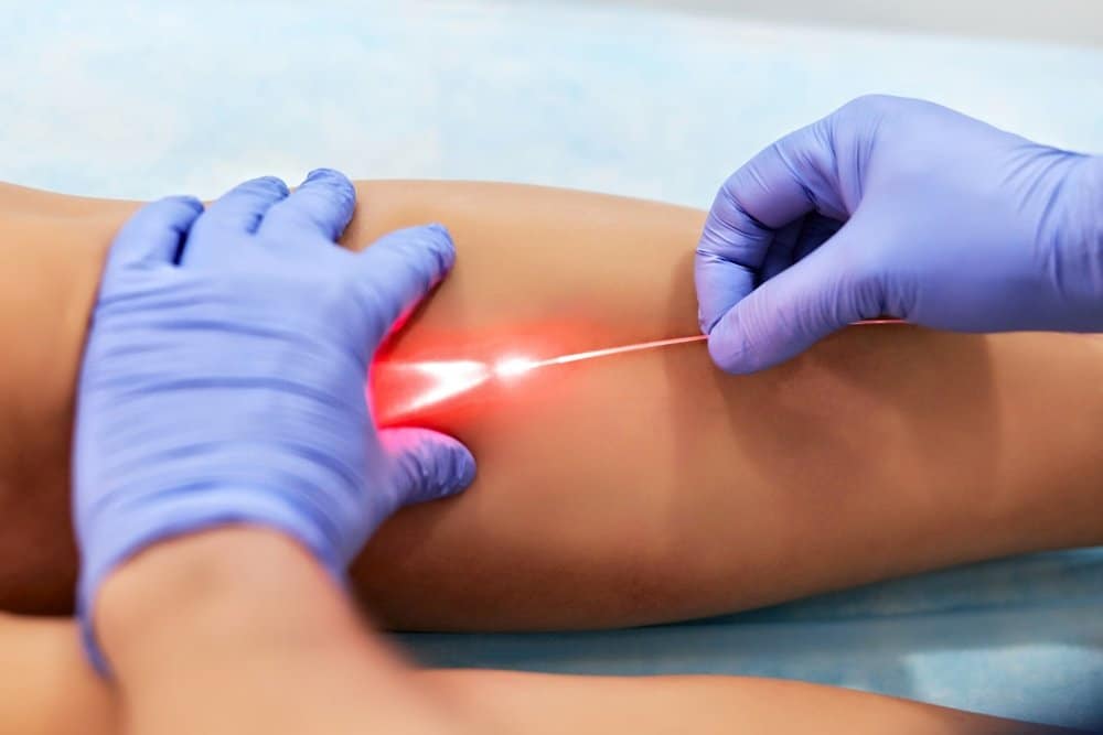 Tips for Speedy Recovery Post Laser Spider Vein Removal