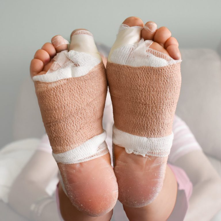 Bunion Surgery Recovery WeekByWeek Guide