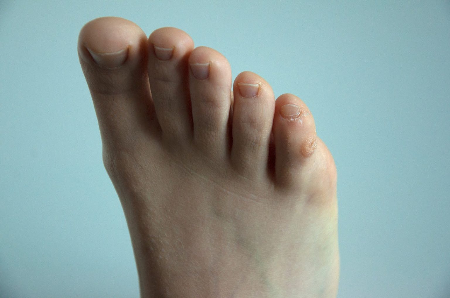 Best Sandals for Tailor's Bunion Comfort Meets Style