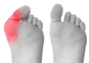 Bunion Surgery Recovery Week-By-Week Guide