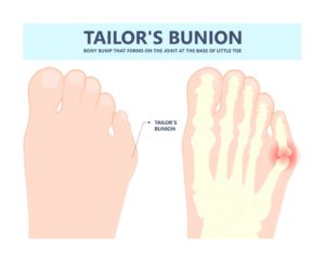 Bunion on the Little Toe