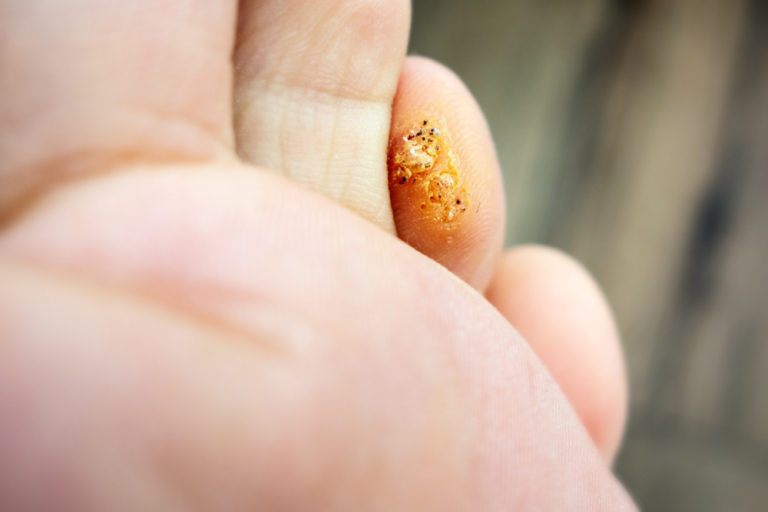 How Does a Podiatrist Remove a Plantar Wart? Expert Insights