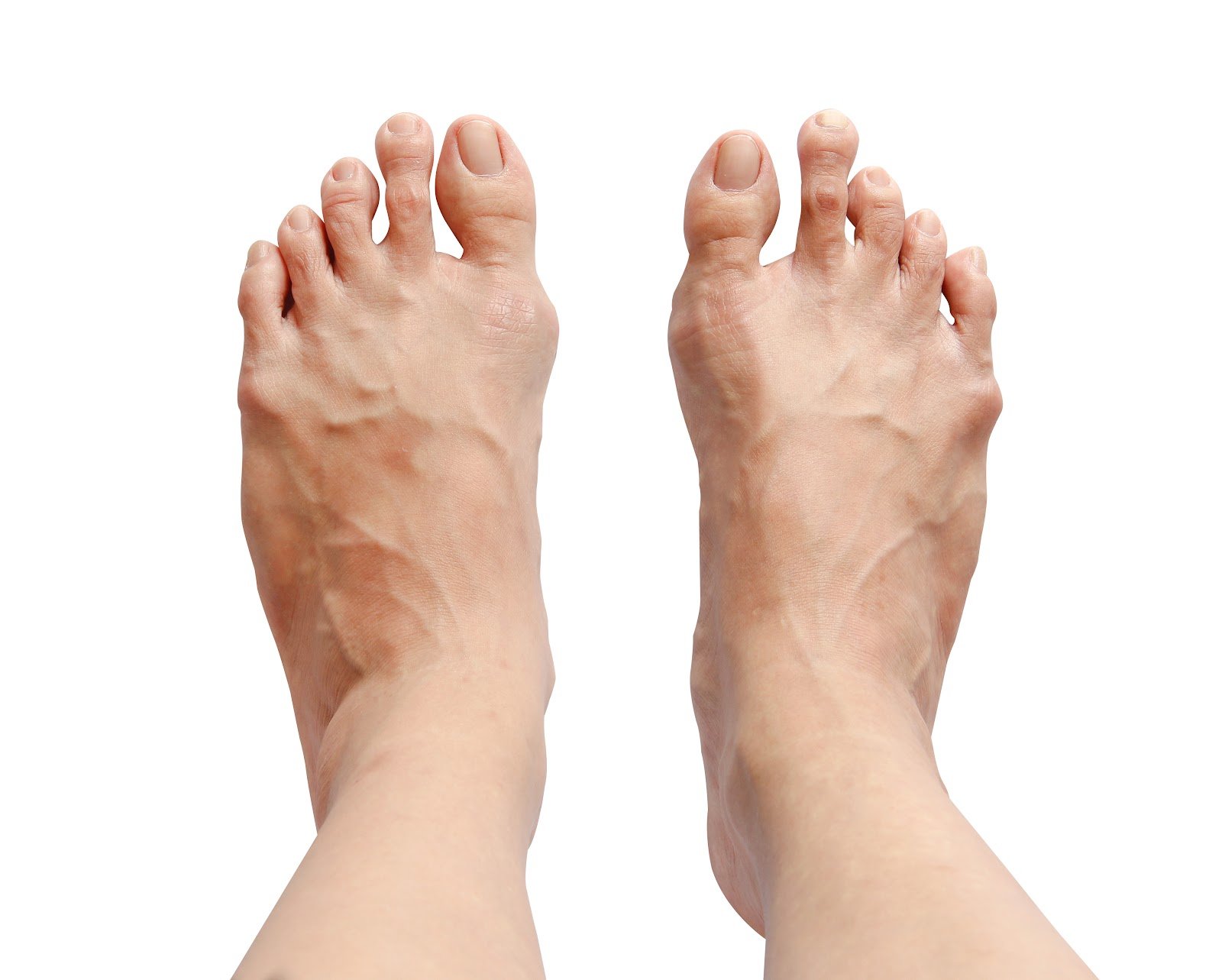 Toe Shortening Procedure What You Need to Know