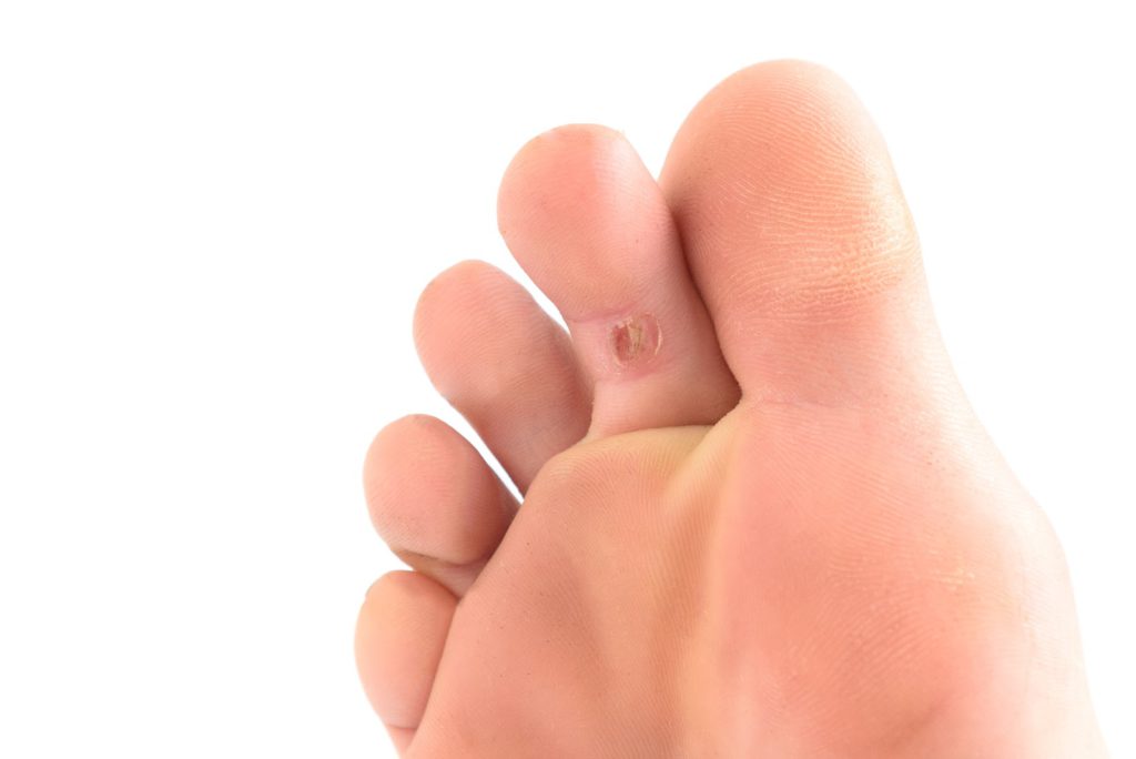 Plantar Wart on Toe Painful Causes and Relief