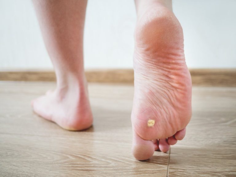 Plantar Wart Pain at Night Causes and Solutions