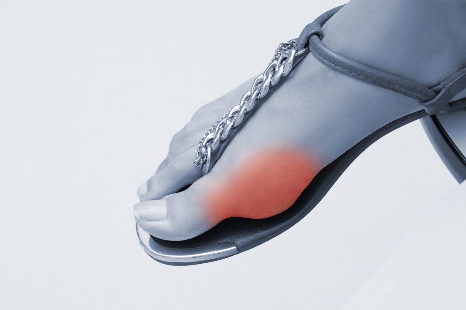 Plantar Wart vs. Callus Unraveling the Mystery