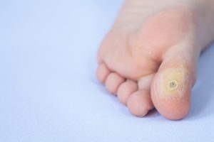When to Consider Plantar Wart-On-Toe Removal Surgery