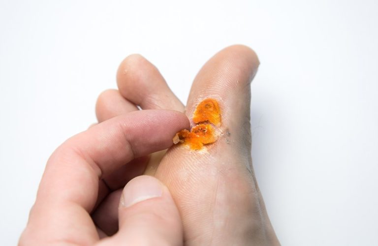 Plantar Wart Surgery Scar Healing and Care Guide