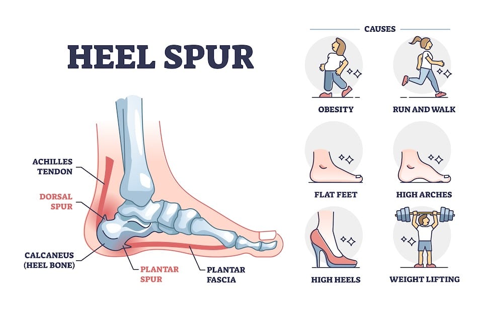 A poster that explains heel spur on the foot