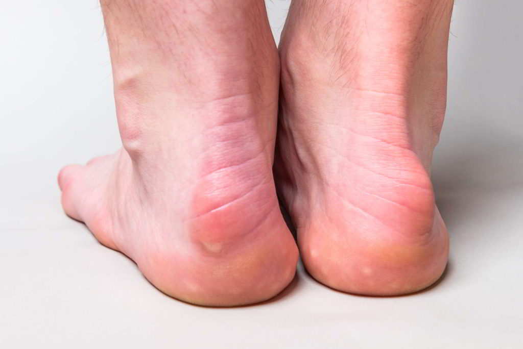 Feet with Haglund's deformity on both heels