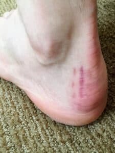 What to Expect - Haglund's Deformity Surgery Scar