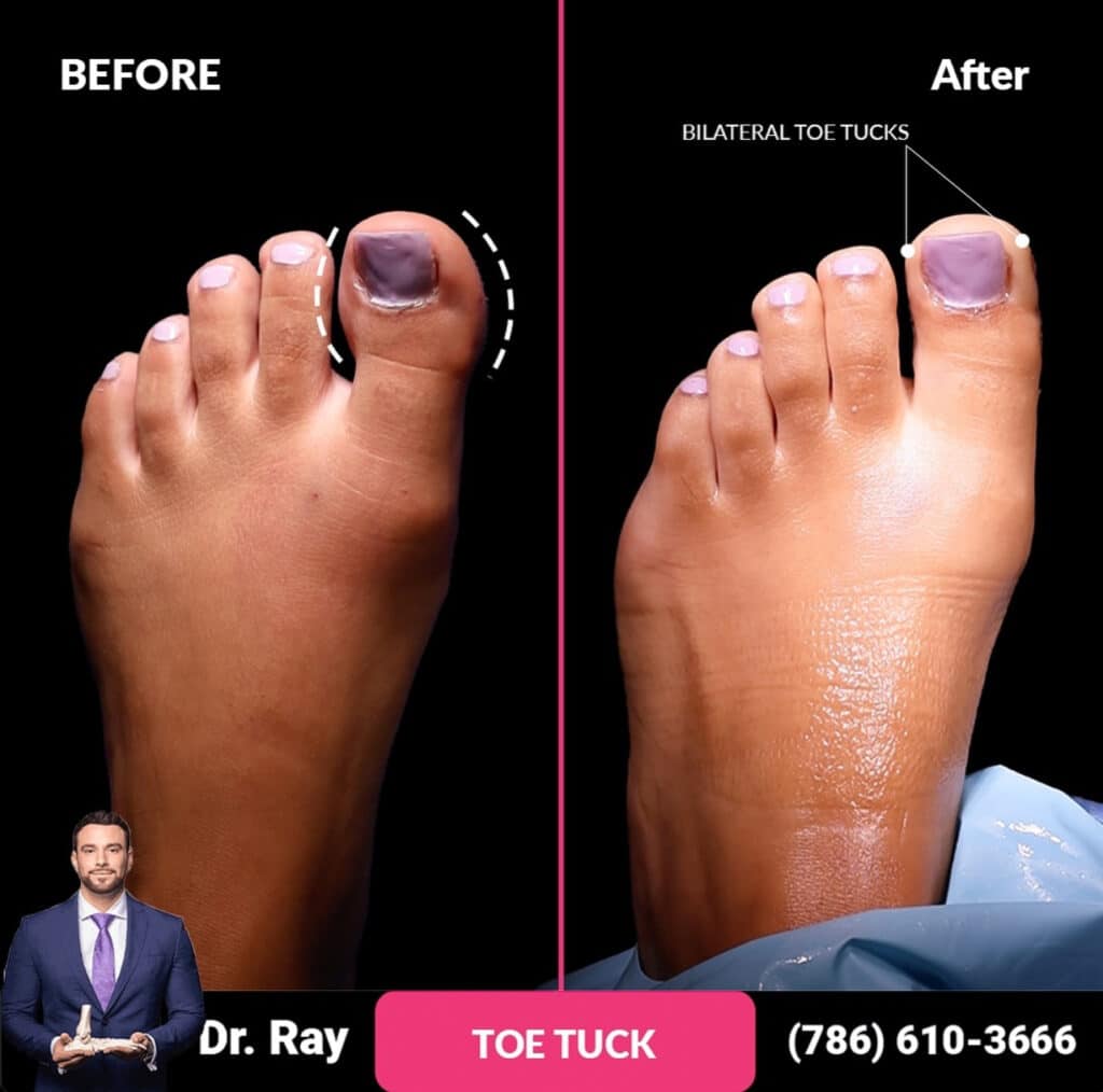 toe tuck surgery